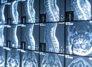 Métastases traitement Casablanca