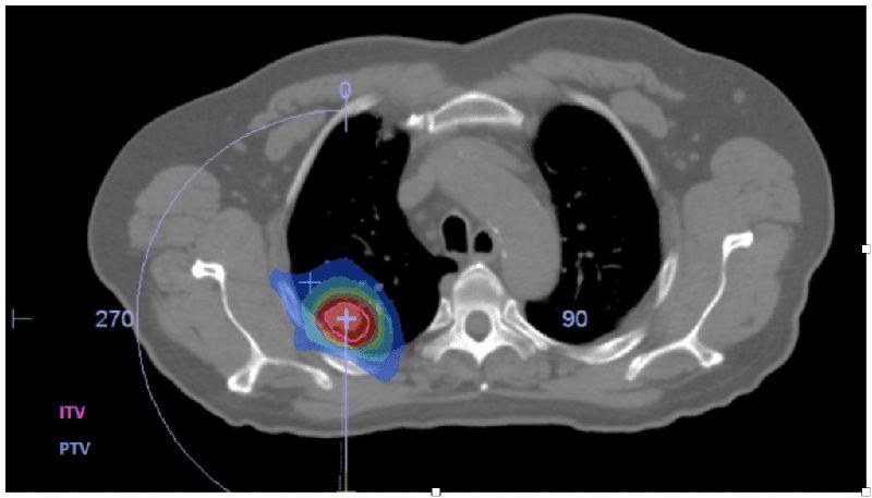 Radiothérapie stéréotaxique (SBRT) : traitement ciblé à Casablanca Casablanca