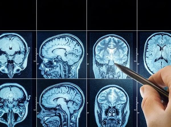 أورام الدماغ بالدار البيضاء